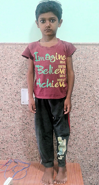 M. Akram After Treatment