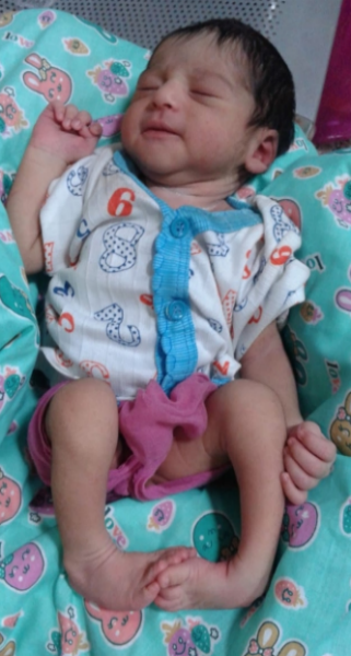 Anjali Before Treatment